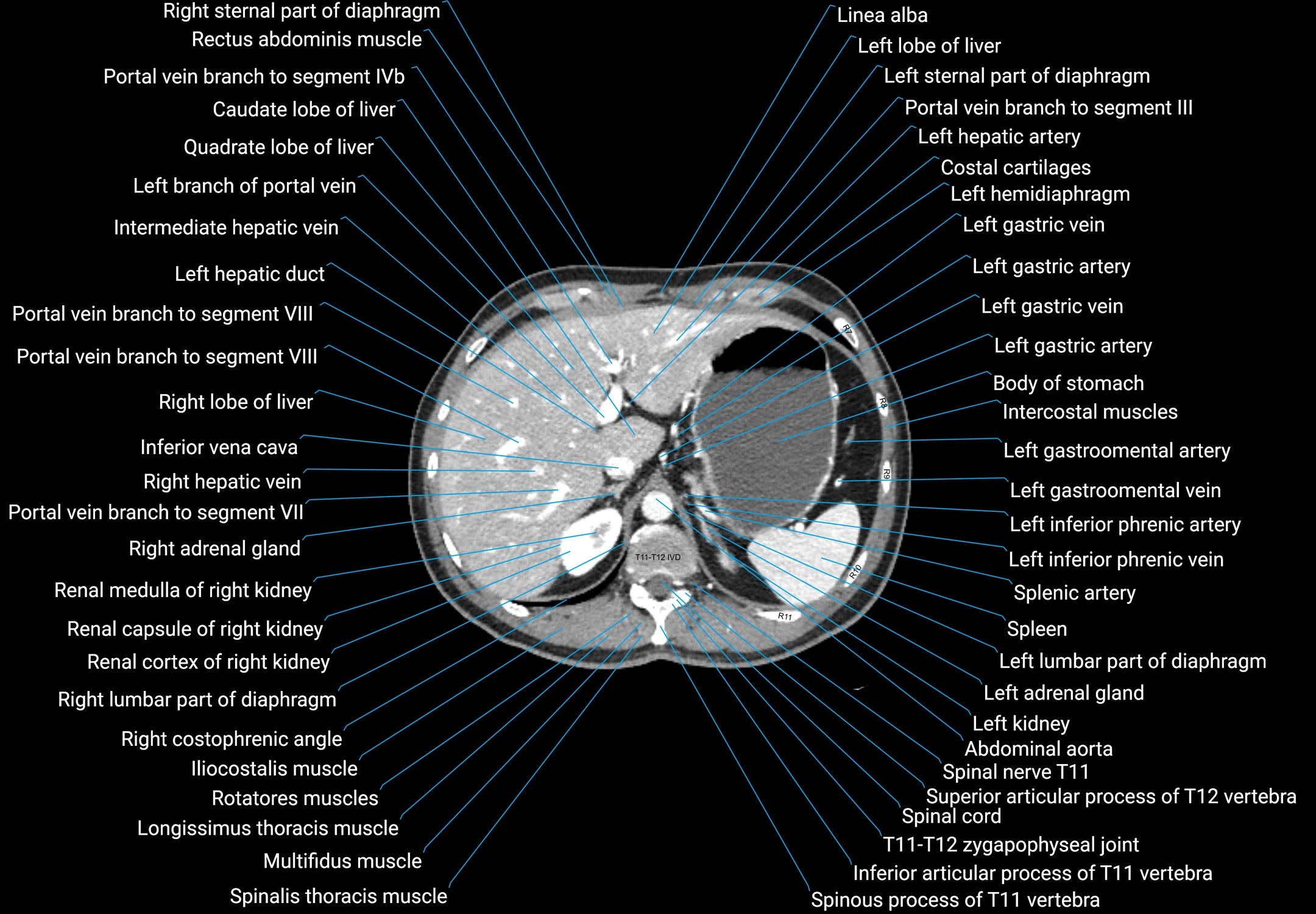 CT male pelvis axial cross sectional anatomy labelled radiology image -00035.webp